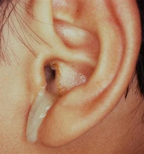 ear leaking clear fluid no pain|Ear Discharge: Causes, Diagnosis, and Treatment